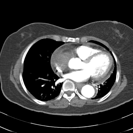 File:Aortic dissection - Stanford type A (Radiopaedia 39073-41259 A 48).png