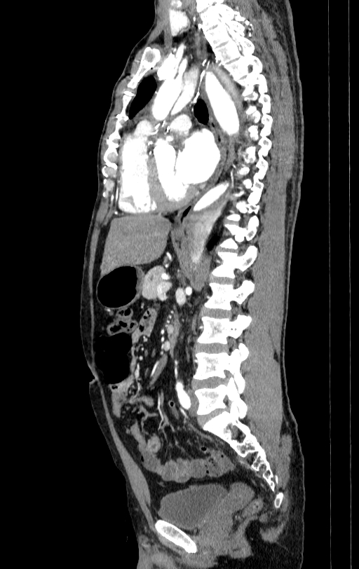 Aortic dissection - Stanford type A (Radiopaedia 83418-98500 B 42).jpg