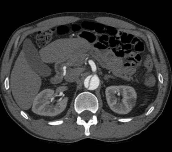 Aortic dissection - Stanford type B (Radiopaedia 73648-84437 A 135).jpg