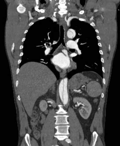 File:Aortic dissection - Stanford type B (Radiopaedia 73648-84437 B 67).jpg