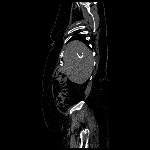 File:Aortic dissection - Stanford type B (Radiopaedia 88281-104910 C 9).jpg
