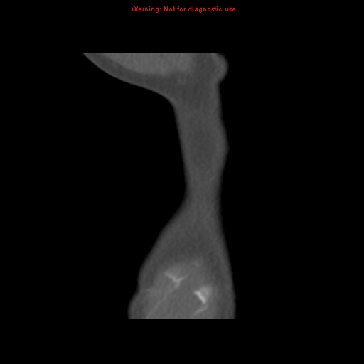 File:Aortic ductus diverticulum (Radiopaedia 8339-9180 C 1).jpg