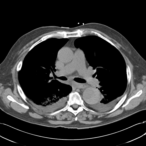 Aortic intramural hematoma (Radiopaedia 34260-35540 Axial non-contrast 28).png