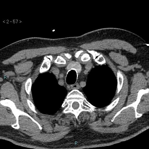 Aortic intramural hematoma (Radiopaedia 48463-53380 Axial non-contrast 25).jpg