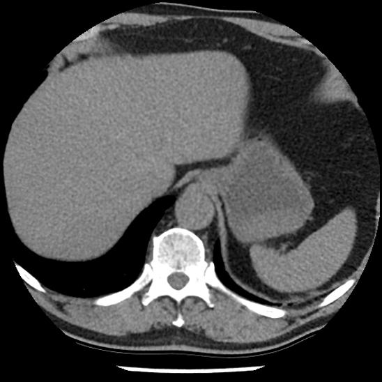 Aortic intramural hematoma (type B) (Radiopaedia 79323-92387 Axial non-contrast 48).jpg