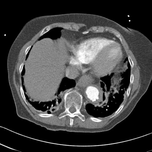 Aortic intramural hematoma from penetrating atherosclerotic ulcer (Radiopaedia 31137-31836 A 62).jpg