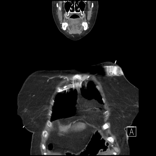 Aortic intramural hematoma with dissection and intramural blood pool (Radiopaedia 77373-89491 C 4).jpg