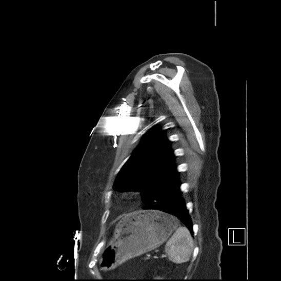 File:Aortic intramural hematoma with dissection and intramural blood pool (Radiopaedia 77373-89491 D 77).jpg