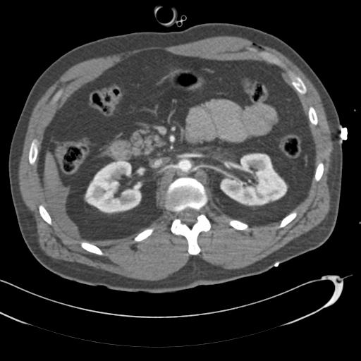 Aortic transection, diaphragmatic rupture and hemoperitoneum in a complex multitrauma patient (Radiopaedia 31701-32622 A 104).jpg