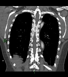 Aortic valve endocarditis (Radiopaedia 87209-103485 D 17).jpg
