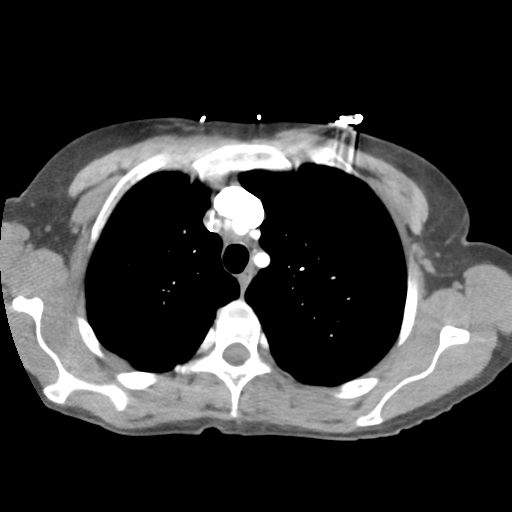 Aortic valve non-coronary cusp thrombus (Radiopaedia 55661-62189 B 12).png