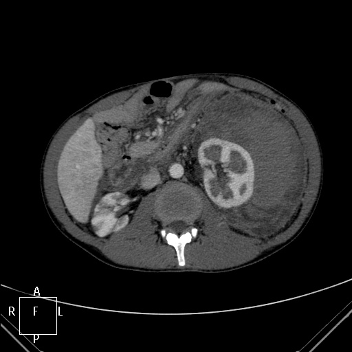 File:Aorto-left renal vein fistula (Radiopaedia 45534-49628 A 27).jpg