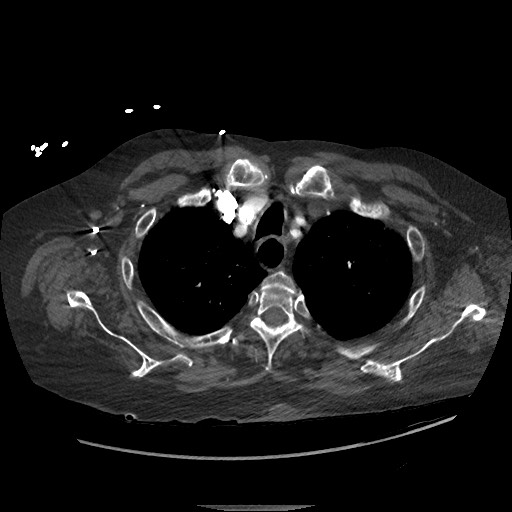 File:Aortoesophageal fistula with endovascular repair (Radiopaedia 73781-84592 Axial C+ CTPA 15).jpg