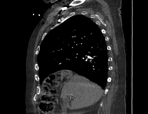 File:Aortoesophageal fistula with endovascular repair (Radiopaedia 73781-84592 Sagittal C+ CTPA 59).jpg