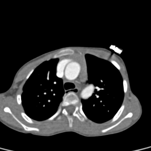 File:Aortopulmonary window, interrupted aortic arch and large PDA giving the descending aorta (Radiopaedia 35573-37074 B 26).jpg