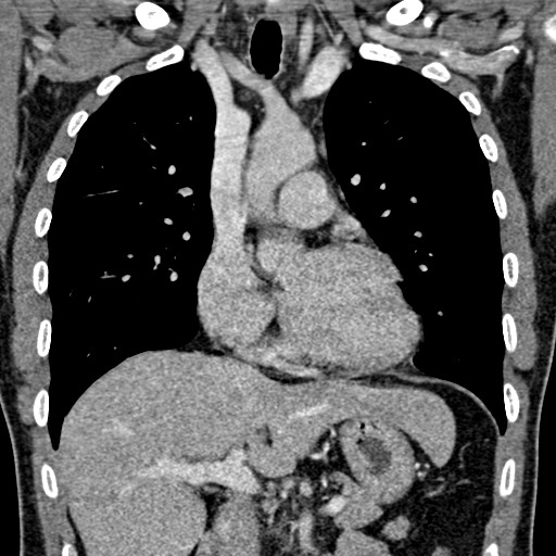 Apical lung mass mimic - neurogenic tumor (Radiopaedia 59918-67521 B 57).jpg