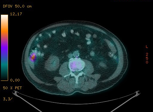 Appendiceal adenocarcinoma complicated by retroperitoneal abscess (Radiopaedia 58007-65041 Axial PET-CT 136).jpg