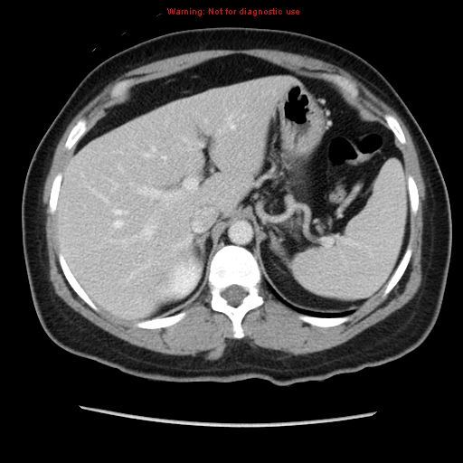 Appendiceal mucinous cystadenoma (Radiopaedia 8263-9111 Axial liver window 23).jpg