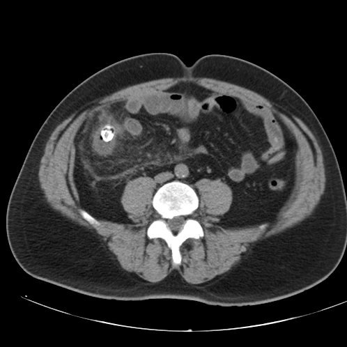 File:Appendicitis and giant appendicolith (Radiopaedia 80251-93588 Axial non-contrast 35).jpg