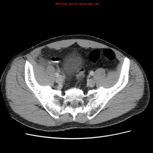 File:Appendicitis and renal cell carcinoma (Radiopaedia 17063-16760 A 45).jpg