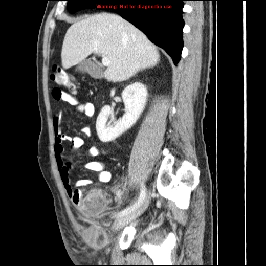 File:Appendicitis mass in inguinal hernia (Radiopaedia 26858-27029 C 18).jpg