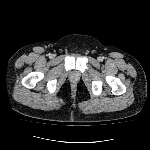 File:Appendicitis with diverticulosis (Radiopaedia 47693-52383 Axial C+ 148).jpg