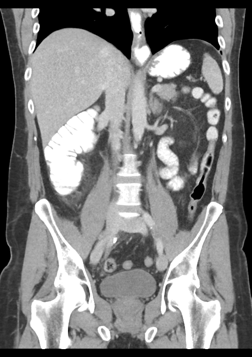 Appendicitis with thickening of the terminal ileum (Radiopaedia 42432-45550 B 33).png
