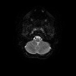 Arachnoid cyst - middle cranial fossa (Radiopaedia 67671-77088 Axial DWI 30).jpg
