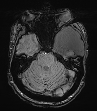 Arachnoid cyst with subdural hematoma (Radiopaedia 85892-101743 Axial SWI 24).png