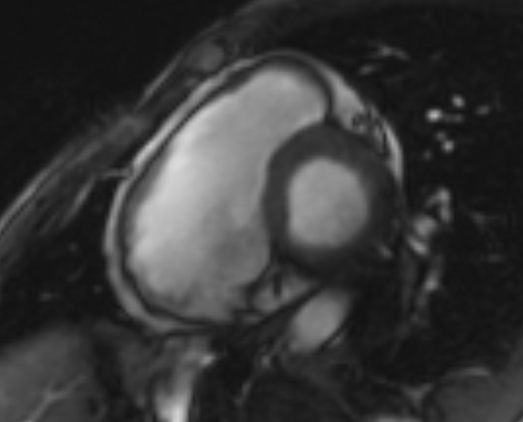 File:Arrhythmogenic right ventricular cardiomyopathy (Radiopaedia 69564-79464 short axis cine 208).jpg