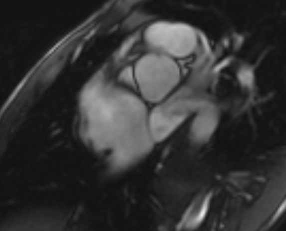 Arrhythmogenic right ventricular cardiomyopathy (Radiopaedia 69564-79464 short axis cine 290).jpg
