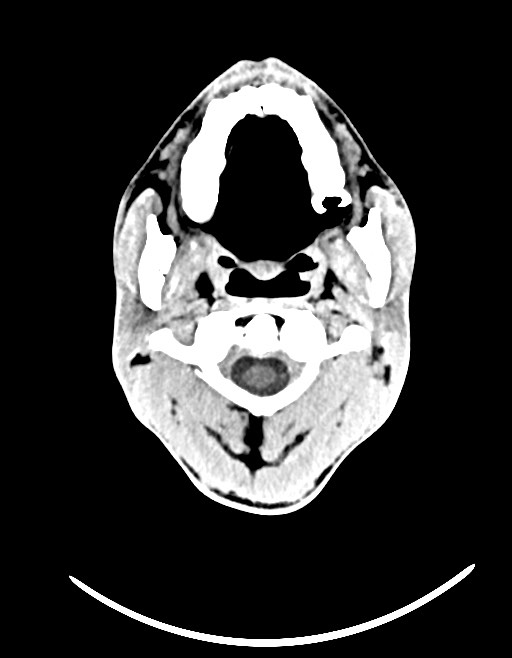 Arrow injury to the brain (Radiopaedia 72101-82607 Axial non-contrast 43).jpg