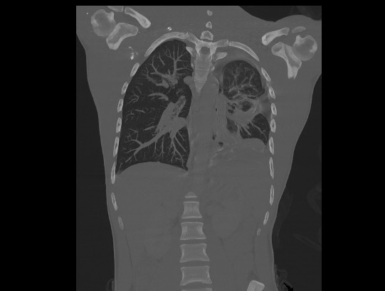 Arrow injury to the chest (Radiopaedia 85367-100975 Axial Bone MIP 1).jpg