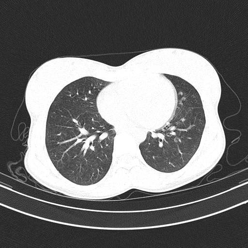 Arteria lusoria (Radiopaedia 88528-105192 Axial lung window 41).jpg