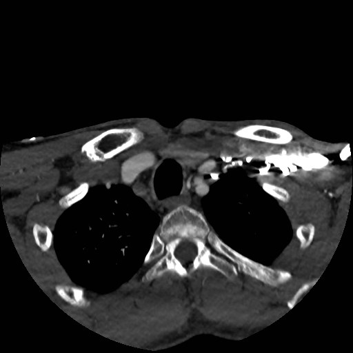 Artery of Percheron infarct (Radiopaedia 48088-52894 A 24).jpg