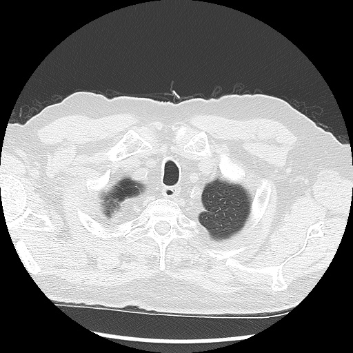 Asbestos-related pleural disease (Radiopaedia 74366-85250 Axial lung window 14).jpg