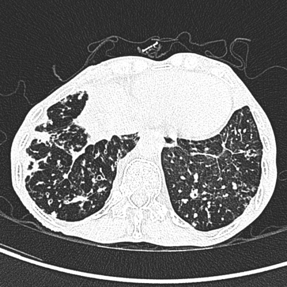File:Aspergilloma- with Monod sign (Radiopaedia 44737-48532 Axial lung window 242).jpg
