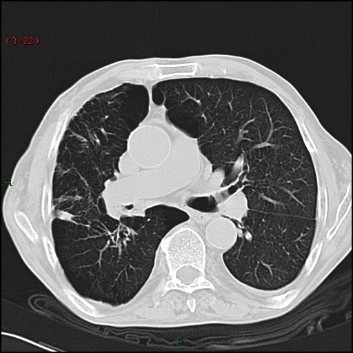 File:Aspergilloma (Radiopaedia 14842-14787 Axial lung window 22).jpg