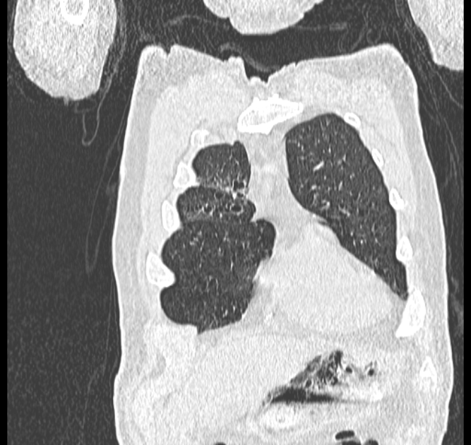 Aspergilloma (Radiopaedia 44592-48327 Coronal lung window 12).jpg