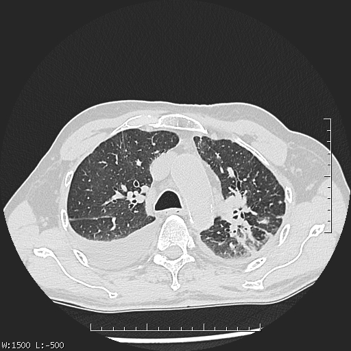 Aspergilloma (Radiopaedia 75184-86270 Axial lung window 16).jpg