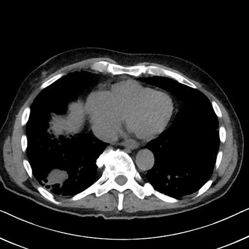 File:Aspergilloma on background pulmonary fibrosis (Radiopaedia 60942-68757 Axial non-contrast 41).jpg