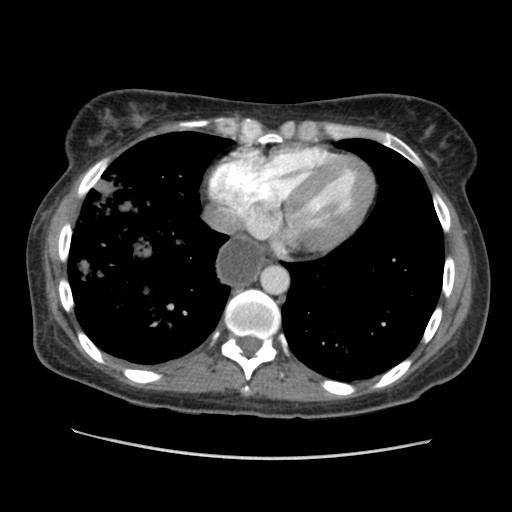 File:Aspiration pneumonia secondary to laparoscopic banding (Radiopaedia 18345-18183 A 38).jpg