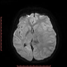 Astroblastoma (Radiopaedia 74287-85162 Axial DWI 55).jpg