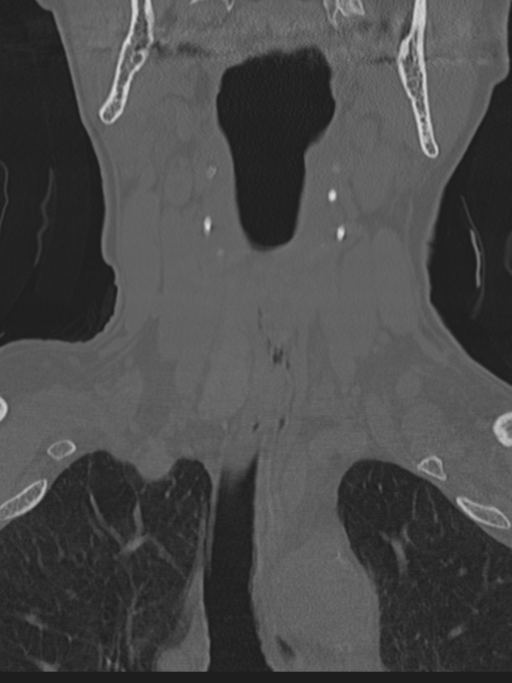 Atlanto-axial subluxation (Radiopaedia 36610-38176 Coronal bone window 7).png