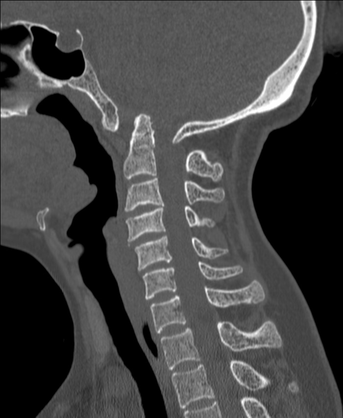 Atlanto-occipital assimilation with basilar invagination (Radiopaedia 70122-80188 Sagittal bone window 65).jpg