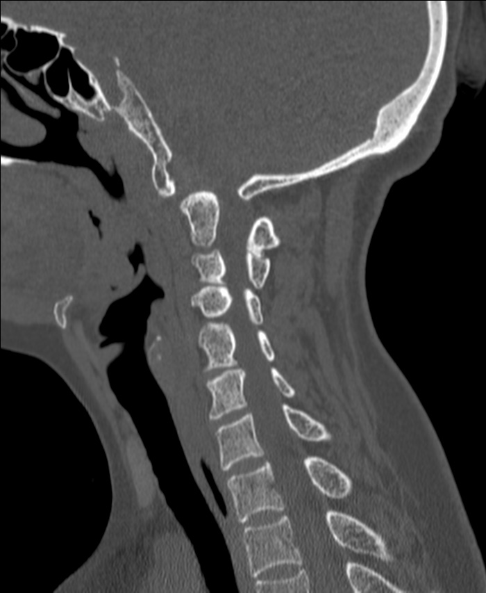 Atlanto-occipital assimilation with basilar invagination (Radiopaedia 70122-80188 Sagittal bone window 85).jpg