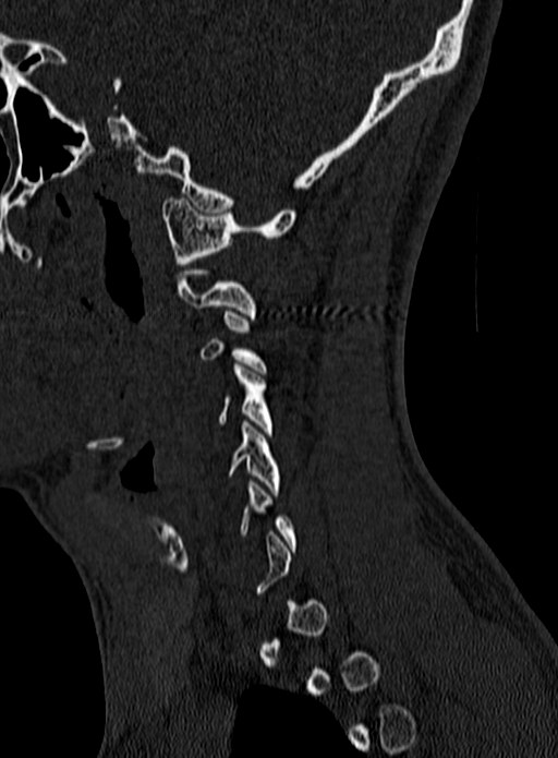 Atlantoaxial subluxation (Radiopaedia 44681-48450 Sagittal bone window 3).jpg