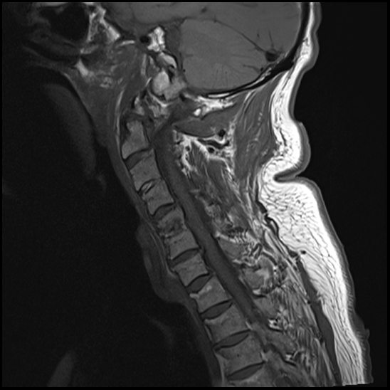 File:Atlas (type 3b subtype 1) and axis (Anderson and D'Alonzo type 3, Roy-Camille type 2) fractures (Radiopaedia 88043-104610 Sagittal T1 8).jpg