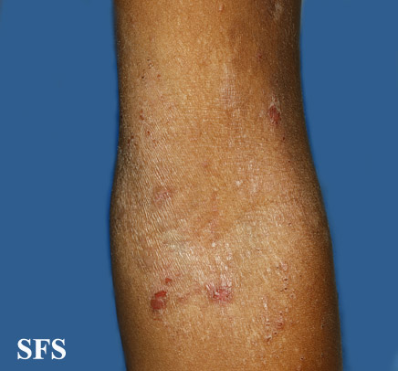 Atopic Dermatitis (Dermatology Atlas 34).jpg