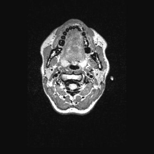 Atretic encephalocoele with inferior vermis hypoplasia (Radiopaedia 30443-31108 Axial 1).jpg